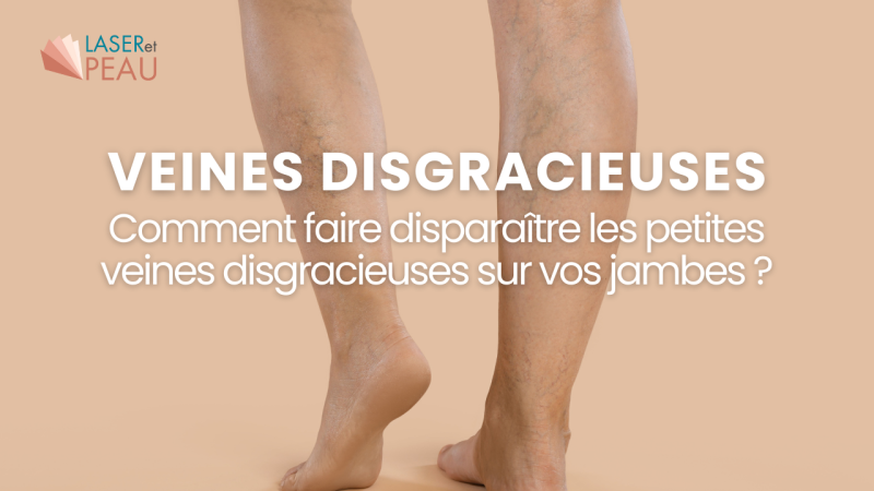 Comment faire disparaître les petites veines disgracieuses sur vos jambes ?