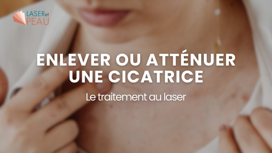 Comment enlever ou atténuer une cicatrice : le traitement au laser